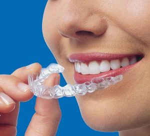 invisalign invisible braces orthodontist